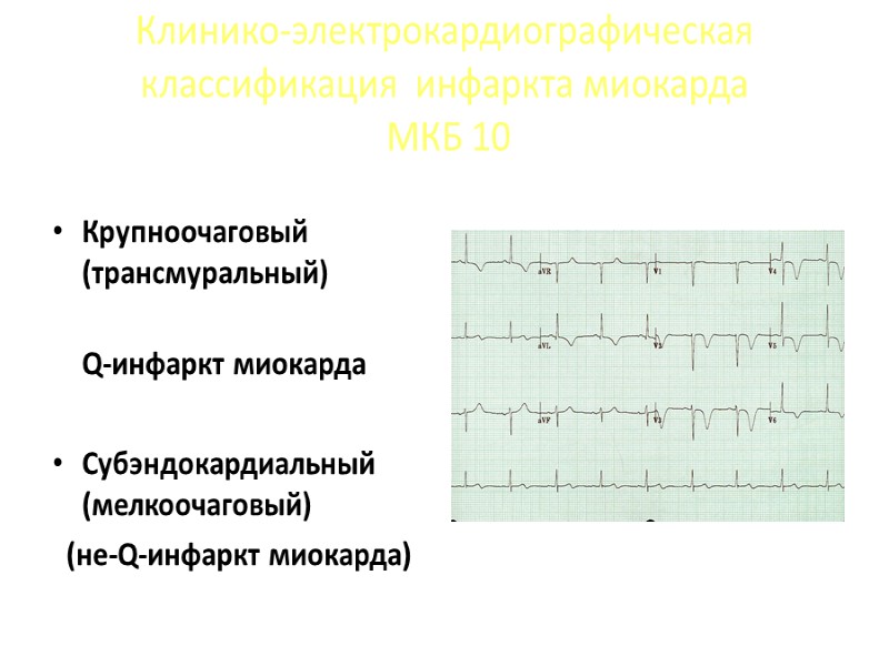 Клинико-электрокардиографическая классификация  инфаркта миокарда  МКБ 10  Крупноочаговый (трансмуральный)   
